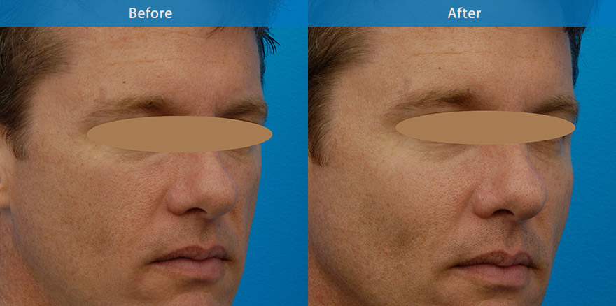 <h3>Case 4</h3><p>This male patient’s intense fitness regime caused rapid weight loss leaving him appearing older and tired. Dermal filler  was used to restore facial fullness, resulting in a natural and refreshed transformation. Longevity 15 to 18 months. Downtime : Patient returned to work immeditely after procedure</p>