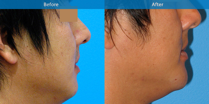 <h3>Case 5</h3><p>Chin implant in a syringe. Dermal was used to provide a chin enhancement. Results lasting 15 months.  Downtime : Patient went back to work after the procedure.</p>