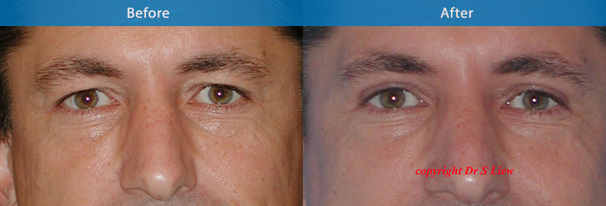 <h3>Case 1</h3><p>A conservative upper eyelift surgery and browpexy ( mini browlifting) to create a natural and brighter eye appearance</p>