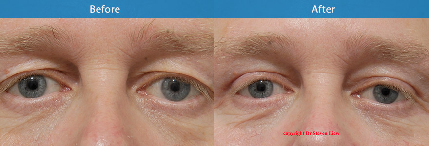 <h3>Case 2</h3><p> A conservative upper eyelift surgery and browpexy ( mini browlifting) to create a natural and brighter eye appearance</p>