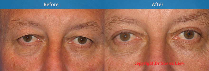 <h3>Case 3</h3><p>A conservative upper eyelift surgery to create a natural and brighter eye appearance on this 58 men</p>