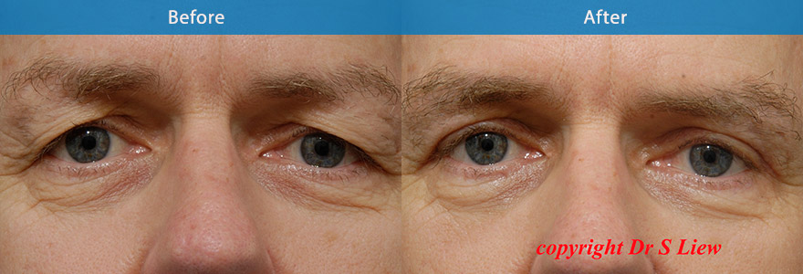 <h3>Case 5</h3><p>In office upper eyelid lift surgery and brow-fixation  to create a brighter and natural looking eye appearance with no tell-tale signs of surgery. Downtime : 5 days</p>