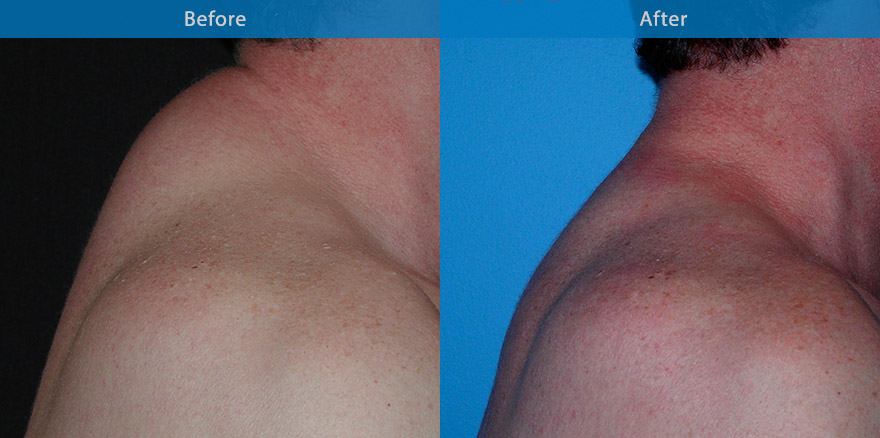 <h3>Case 1</h3><p>A severe case of buffalo hump. Excellent reduction of the hump at 3 months  following Vaser ultrasonic liposuction.</p>