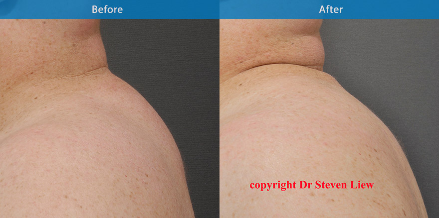 <h3>Case 3</h3><p>A longstanding moderate size buffalo hump on this man, who can no longer fit into his business (collar shirt ). An optimal result 6 weeks post ultrasonic liposuction (VASER)</p>