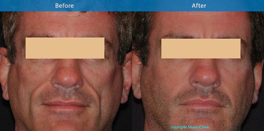 <h3>Case 1</h3><p>This gentleman has a condition termed facial lipoatrohy which can be associated with certain illness, creating  tired and gaunt like features. Specialised dermal filler was used  on a yearly basis to restore the fullness and maintaining a natural and healthy appearance</p>
