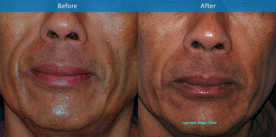 <h3>Case 2</h3><p>This gentleman has a condition termed facial lipoatrohy which can be associated with certain illness, creating tired and gaunt like features. Specialised dermal filler was used  on a yearly basis to restore the fullness and maintaining a natural and healthy appearance</p>