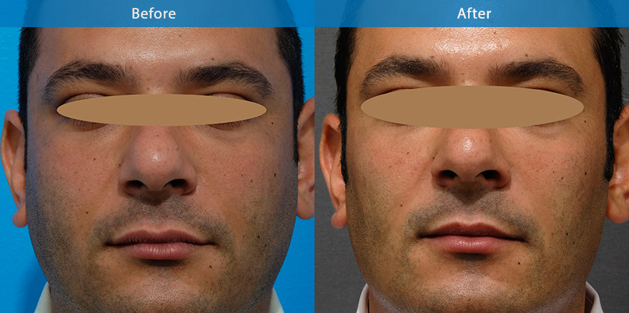 <h3>Case 1</h3><p>This patient wanted to appear more masculine. Btx injection was used to slim the lower face. V gel was used to enhance the chin and jawline. The result:  a more angular, chiselled chin and strong jawline. Longevity ~ 18  - 24 months</p>