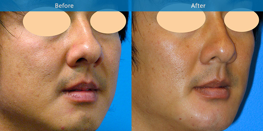 <h3>Case 2</h3><p>This patient wanted more angular lower face.  Antiwrinkle injection was used to recontour  and to slim the lower face. Dermal filler to enhance the chin . The result is a very angular lower face, chiselled chin and strong jawline. Longevity ~ 18 months- 24 mths for fillers. </p>
