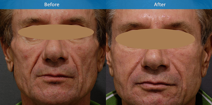 <h3>Case 3</h3><p>This patient wanted more angular lower face.  Antiwrinkle injection was used to recontour  and to slim the lower face. Dermal filler to enhance the chin . The result is a very angular lower face, chiselled chin and strong jawline. Longevity ~ 18 months- 24 mths for fillers. </p>