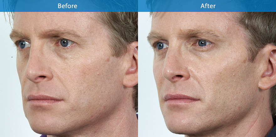 <h3>Case 4</h3><p>This patient wanted a total facial re-shaping to enhance his appearance. The procedures included antiwrinkle treatment to lift drooping eyebrows and   eyelids. Derma filler to restore his sunken cheeks and soften the cheek fold and strengthen the angle of his jaw line. Antiwrinkle  injection to elevate the tip of his nose. The result is a more  youthful ,fresher and masculine appearance.</p>