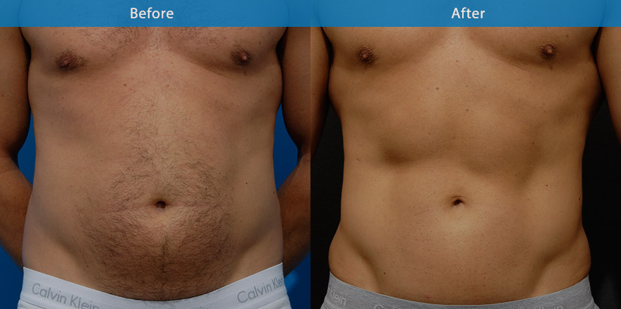 <h3>Case 1</h3><p>Vaser High Definition Liposculpture ( advanced liposculpting technique with ultrasonic energy)was performed on this man’s abdomen to create a sculpted  athletic  appearance.</p>