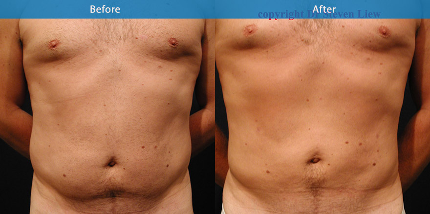 <h3>Case 2</h3><p>Vaser High Definition Liposculpture ( advanced liposculpting technique with ultrasonic energy)was performed on this man’s abdomen and love handles. The result was a flatter abdomen and a slimmer waistline</p>