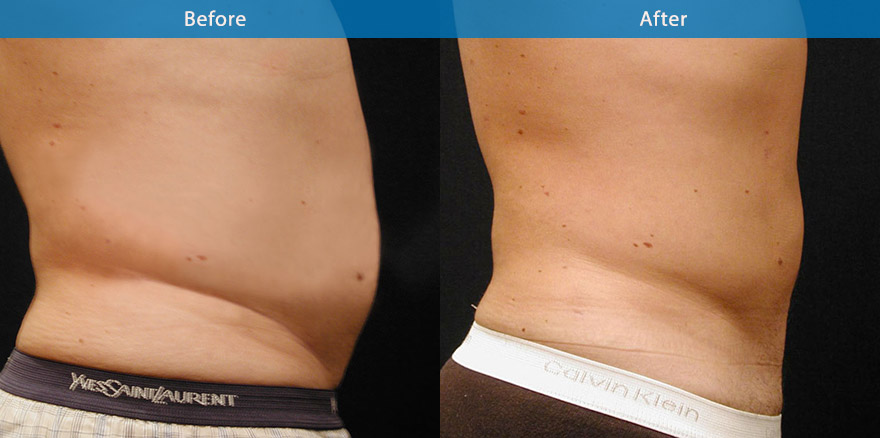 <h3>Case 2</h3><p>Vaser High Definition Liposculpture ( advanced liposculpting technique with ultrasonic energy)was performed on this man’s abdomen and love handles. The result was a flatter abdomen and a slimmer waistline</p>
