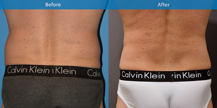 <h3>Case 4</h3><p>Vaser High Definition Liposculpture ( advanced liposculpting technique with ultrasonic energy)was performed on this man’s abdomen and “love handles”. The result was a flatter abdomen and narrower waistline.</p>
