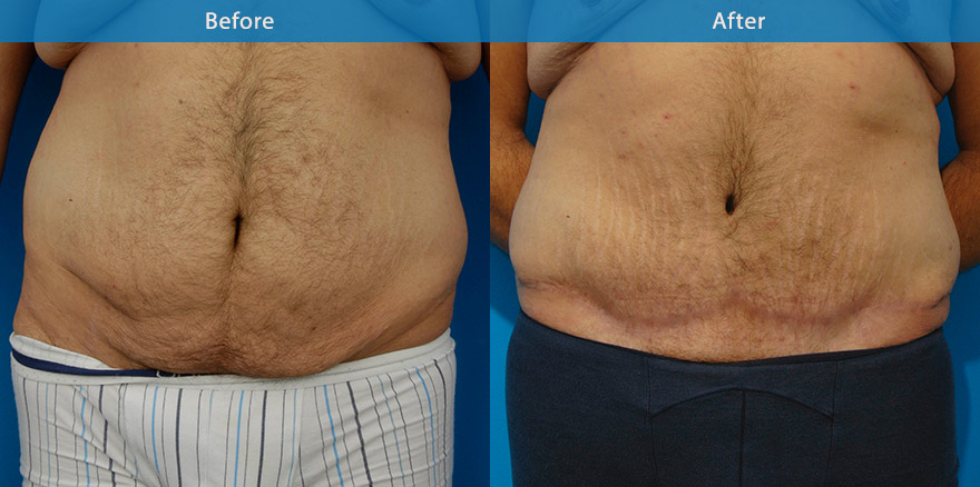 <h3>Case 2</h3><p>5 month following a stage 1: tummy tuck surgery incorporating liposuction and excision of the excess skin following massive weight loss in a young man. Further surgery is planned for removal of the excess skin of the chest , waistline and back to reshape the whole chest and body. The resultant scar is expected to fade further with time.</p>