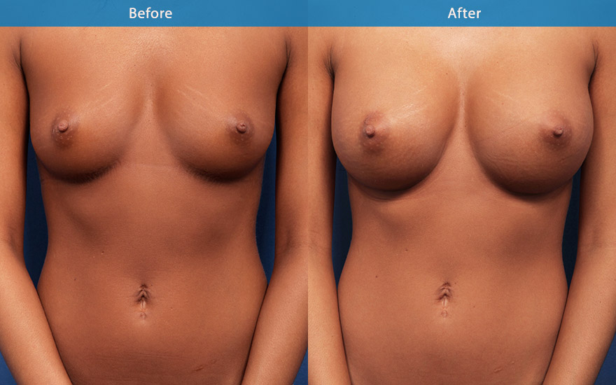 <h3>Case 1</h3><p>27 female who love to swim and surf. She has a small petite frame and B cup breasts. She likes to have more fullness to her breasts and not wanting to ever wear padded bikini top again.</p><p>Moderate profile round implants were chosen and placed in dual plane fashion to create a moderate and proportionate enhancement from B to full D cup. The new breasts look voluptuous without the excessive bulge in the upper pole.</p>