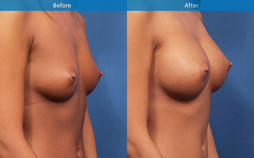 <h3>Case 1</h3><p>27 female who love to swim and surf. She has a small petite frame and B cup breasts. She likes to have more fullness to her breasts and not wanting to ever wear padded bikini top again.</p><p>Moderate profile round implants were chosen and placed in dual plane fashion to create a moderate and proportionate enhancement from B to full D cup. The new breasts look voluptuous without the excessive bulge in the upper pole.</p>