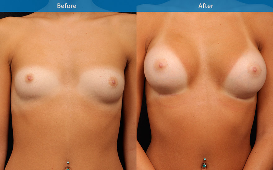 <h3>Case 10</h3><p>21 female who loves to swim and hangout on the beach. She has a small petite frame and A cup breasts. She likes to have more fullness to her breasts and not wanting to ever wear padded bikini top again.</p><p>Significant asymmetry was noted with her left breast sitting lower than the right.</p><p>High profile round implants were chosen and placed in dual plane fashion and positioned slightly higher on her left breast to create better symmetry and a moderate and proportionate enhancement from B to D cup. The new breasts look aesthetically pleasing without the excessive bulge in the upper pole.</p>