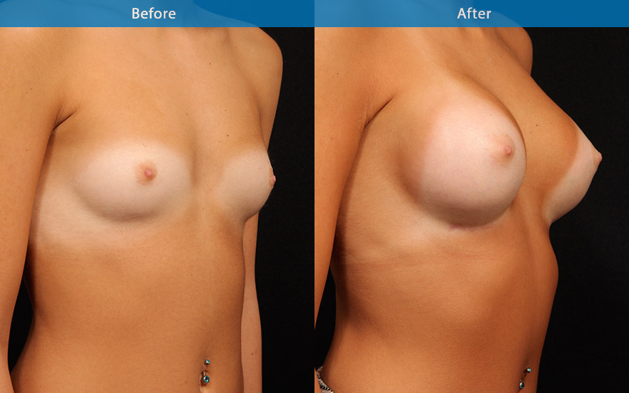 <h3>Case 10</h3><p>21 female who loves to swim and hangout on the beach. She has a small petite frame and A cup breasts. She likes to have more fullness to her breasts and not wanting to ever wear padded bikini top again.</p><p>Significant asymmetry was noted with her left breast sitting lower than the right.</p><p>High profile round implants were chosen and placed in dual plane fashion and positioned slightly higher on her left breast to create better symmetry and a moderate and proportionate enhancement from B to D cup. The new breasts look aesthetically pleasing without the excessive bulge in the upper pole.</p>