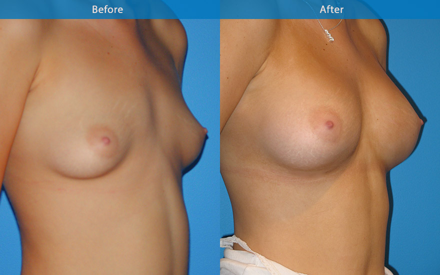 <h3>Case 11</h3><p><strong>Patient details: </strong></p><p>22 lingerie model. 5 ft 11. "I always felt my breast are too small compare to my tall frame" Like to have a more proportionate breast enlargement to fit into bras and also to further her career as model.</p><p><strong>Surgical Plan</strong></p><p>A slender tall lady with A cup breasts. C Cup was agreed upon to suit her frame and her career as a model. The main goal is to get a perfectly shaped breast with optimal size for herself and her career. A 350gm moderate profile round implant was chosen in a DUALPLANE fashion to camouflage the implant and to reduce risks of double bubble. The end result is a full C Cup with moderate cleavage, perfectly shaped beautiful breasts. She is now a successful lingerie model in United States.</p>