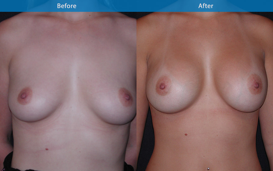 <h3>Case 12</h3><p><strong>Patient details:</strong></p><p>Aged 29, requesting B cup to D cup. Would like a deeper cleavage.</p><p><strong>Surgical Plan</strong></p><p>425 gm high profile round implants were used to increase the projection of this breasts which demonstrate some premature sagginess. It deepened, enhanced the cleavage and increase the overall fullness as requested. B to D cup.</p>