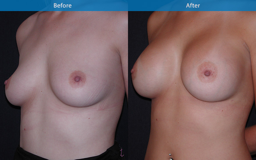 <h3>Case 12</h3><p><strong>Patient details:</strong></p><p>Aged 29, requesting B cup to D cup. Would like a deeper cleavage.</p><p><strong>Surgical Plan</strong></p><p>425 gm high profile round implants were used to increase the projection of this breasts which demonstrate some premature sagginess. It deepened, enhanced the cleavage and increase the overall fullness as requested. B to D cup.</p>