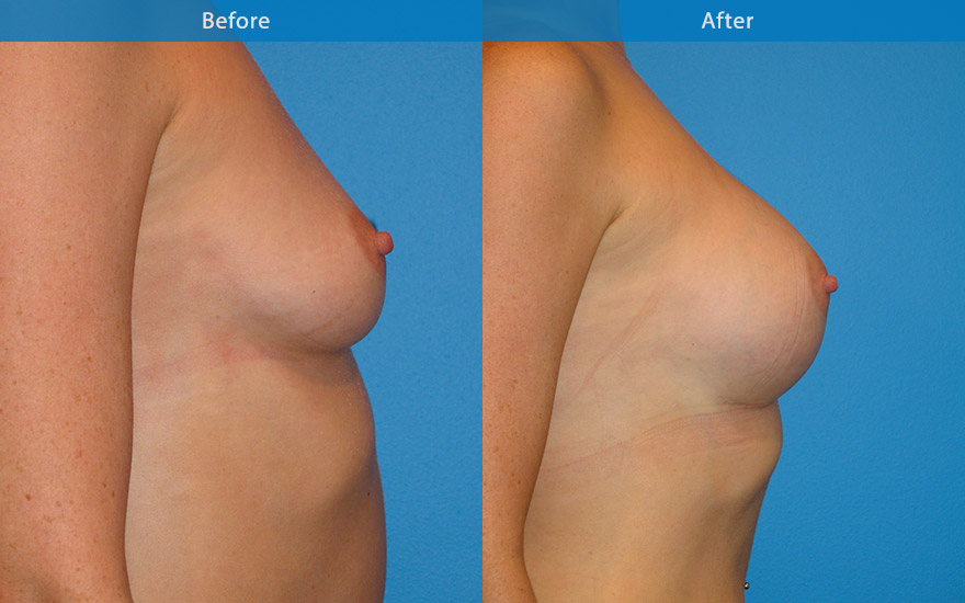 <h3>Case 13</h3><p>An athletic lady, requested moderate breast enhancement with fuller upper pole. A 300 gm high profile round implant placed in subfascial plane was used to create a full C cup breast that balanced her body profile and yet allowed her to continue her active athletic lifestyle.</p>