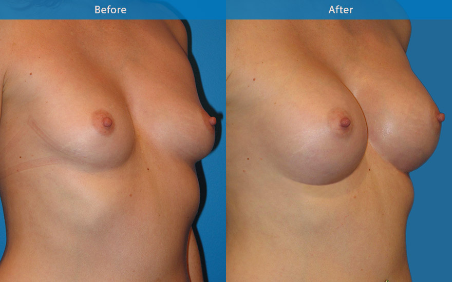 <h3>Case 13</h3><p>An athletic lady, requested moderate breast enhancement with fuller upper pole. A 300 gm high profile round implant placed in subfascial plane was used to create a full C cup breast that balanced her body profile and yet allowed her to continue her active athletic lifestyle.</p>