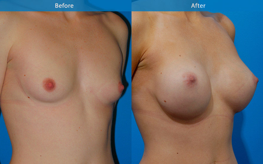 <h3>Case 14</h3><p>A young patient, 165 cm tall. Wanted fuller and rounder breasts that still looked " natural". She did not want excessive fullness to the top part of the breast .A small D cup breast was created, providing attractive natural looking breasts.</p>