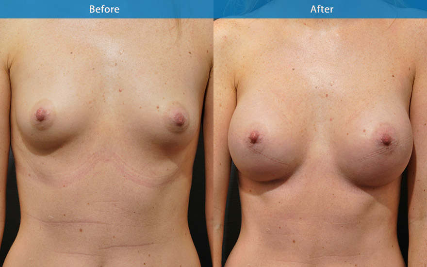 <h3>Case 15</h3><p>29 F requested breast enhancement so she could fit better into some pretty dresses without necessary required padded bras.</p><p>She requested the breasts to look as natural as possible with a tear drop breast shape. She did not like too much bulge on the top part which she felt look rather fake.</p><p>Clinically, she has some degree of asymmetries in the breast size. Moderate proportionate breast enhancement from A to small D cup was achieved with different size moderate profile round implants to complement her 165 cm frame.</p>