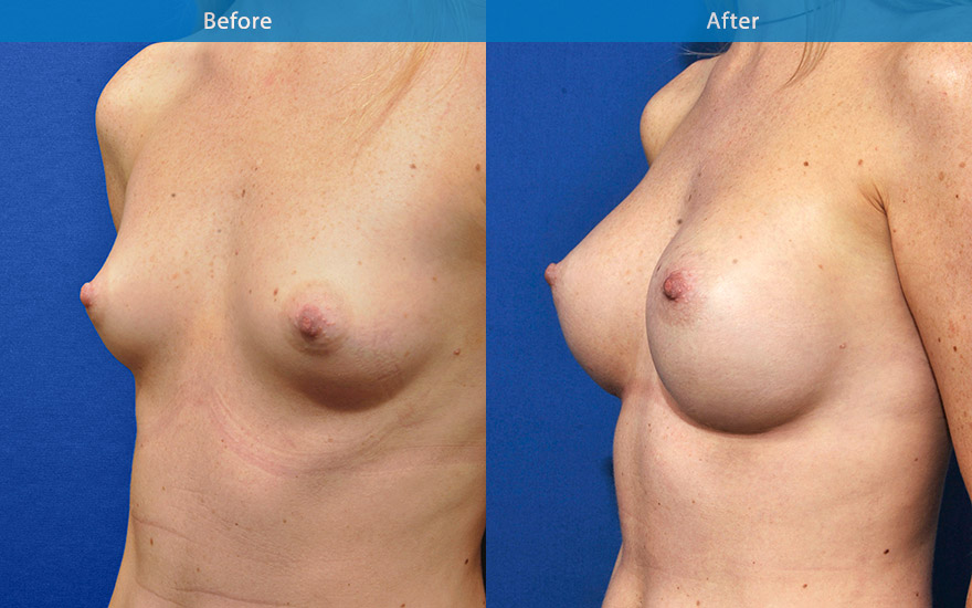 <h3>Case 15</h3><p>29 F requested breast enhancement so she could fit better into some pretty dresses without necessary required padded bras.</p><p>She requested the breasts to look as natural as possible with a tear drop breast shape. She did not like too much bulge on the top part which she felt look rather fake.</p><p>Clinically, she has some degree of asymmetries in the breast size. Moderate proportionate breast enhancement from A to small D cup was achieved with different size moderate profile round implants to complement her 165 cm frame.</p>