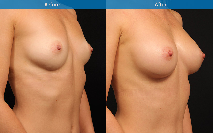<h3>Case 16</h3><p>34 female who is fit and do regular pole dancing as a form of core workout.. She has a small petite frame and A cup breasts. She likes to have a very natural breast enhancement with gentle slope to the upper part of her breasts.</p><p>Preoperatively, she was found to have some asymmetry in that her rib cage was more prominent on her right giving the appearance of a larger breast on her right.</p><p>A different size tear drop implants were chosen for her breast enhancement. .This result at 6 weeks after surgery showed nicely enhanced breasts with some residual swelling. In 3 months the asymmetry will further improve and the breast will look softer and even more natural.</p>