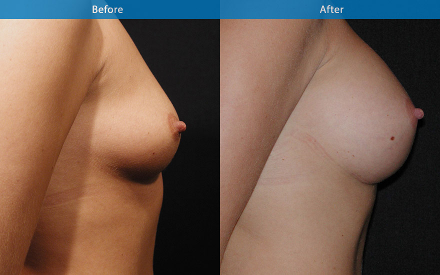 <h3>Case 17</h3><p>27 female, requesting moderate and proportionate breast augmentation from B cup. She is 5’ 4" with some emptiness in the upper and outer part of breast. A 275 gm moderate profile round implant placed in subfascial plane ( on top of muscle but a layer deeper than breast tissue) to create C cup breast with moderate fullness to the top part of the breast as requested. A profile view demonstrated a gentle slope towards a well positioned nipple with no evidence of implant bulges.</p>