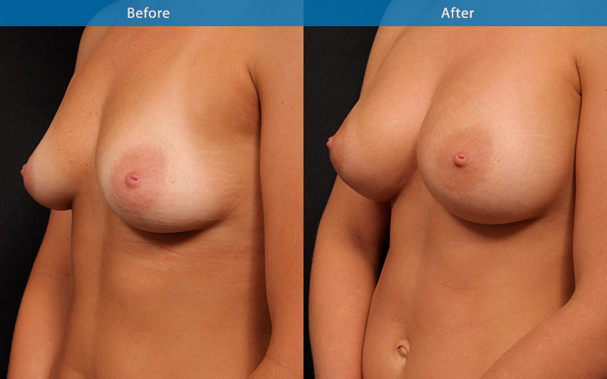 <h3>Case 18</h3><p><strong>Mummy make over</strong></p><p>This 42 year old mother of three requested breast enlargement to restore the loss breast fullness from pregnancies and the " curves" she used to have. Large D cup shape breasts were created with moderate profile round implent to complement her body, personality and restoring the "curves"</p>