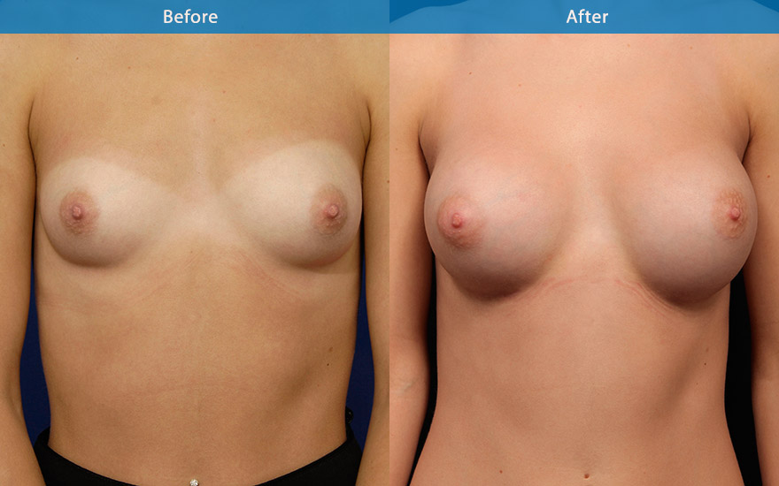 <h3>Case 2</h3><p>23 female requesting moderate size breast augmentation. She likes to have enough fullness to look good in a dress without any bra but not look fake with excessive bulge on the upper part of the breasts</p><p>High profile round implants placed behind the muscle creating D cup breast as requested. The upper pole has enough fullness without the excessive fake bulge. The end result is a well proportionate body with a nice side of breast curve which further accentuate the slimness of her waist.</p>