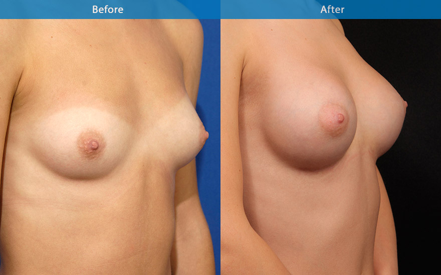 <h3>Case 2</h3><p>23 female requesting moderate size breast augmentation. She likes to have enough fullness to look good in a dress without any bra but not look fake with excessive bulge on the upper part of the breasts</p><p>High profile round implants placed behind the muscle creating D cup breast as requested. The upper pole has enough fullness without the excessive fake bulge. The end result is a well proportionate body with a nice side of breast curve which further accentuate the slimness of her waist.</p>
