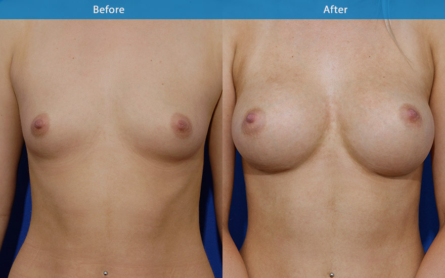 <h3>Case 3</h3><p>23 female requesting moderate size breast augmentation. She likes to have enough fullness to look good in a dress without any bra but not look fake with excessive bulge on the upper part of the breasts</p><p>High profile round implants placed behind the muscle creating D cup breast as requested. The upper pole has enough fullness without the excessive fake bulge. The end result is a well proportionate body with a nice side of breast curve which further accentuate the slimness of her waist.</p>