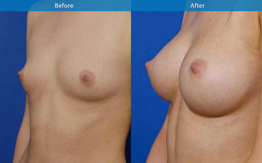 <h3>Case 3</h3><p>23 female requesting moderate size breast augmentation. She likes to have enough fullness to look good in a dress without any bra but not look fake with excessive bulge on the upper part of the breasts</p><p>High profile round implants placed behind the muscle creating D cup breast as requested. The upper pole has enough fullness without the excessive fake bulge. The end result is a well proportionate body with a nice side of breast curve which further accentuate the slimness of her waist.</p>