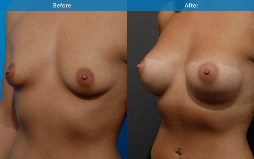 <h3>Case 4</h3><p>This lady wanted a fuller and rounder breasts that still looked "natural".</p><p>Round high profile implants were used to enhanced her breasts from A small D cup . The implants create moderate degree of fullness to the top part of her breasts. The improved appearance of the breasts also provide attractive new curves to her body.</p>