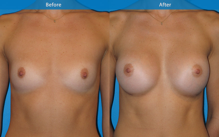 <h3>Case 5</h3><p><strong>Patient details:</strong></p><p>32 professional dance instructor, 5feet 11, like to have C/D cup breast that is not too full so as to not get in the way of her dancing, but will enhance her slim appearance.</p><p><strong>Surgical Plan</strong></p><p>A slender and tall lady with minimal breast tissue. The main aim is to select an implant to achieve the size requested but also wide enough to camouflage her rib cage. 350gm moderate profile round implants were and placed under the muscle to achieve the goals above. The end result is a beautifully enhanced full C cup breast that is not too full but also cover her ribcage and enhance her hour glass female body form.</p>