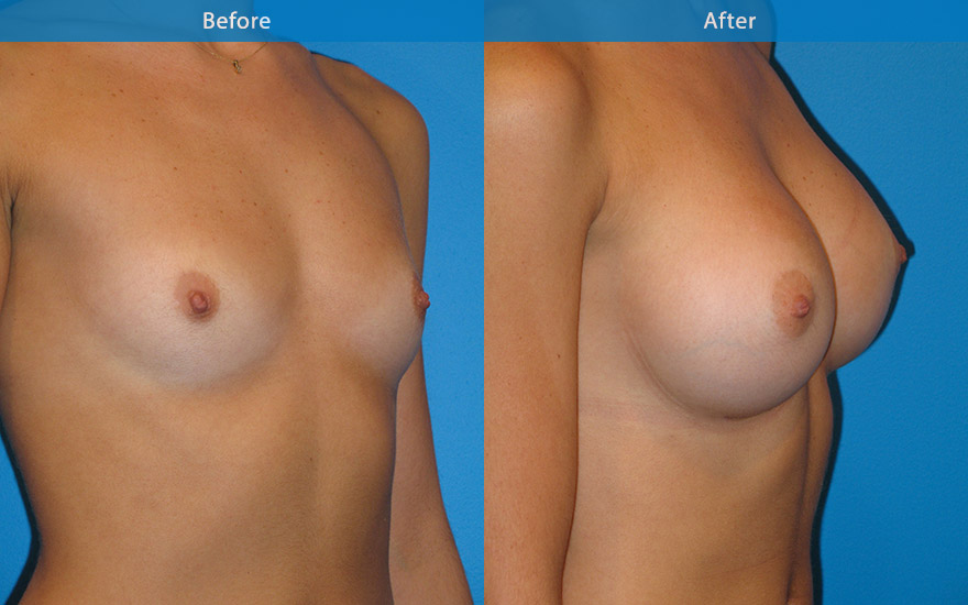 <h3>Case 5</h3><p><strong>Patient details:</strong></p><p>32 professional dance instructor, 5feet 11, like to have C/D cup breast that is not too full so as to not get in the way of her dancing, but will enhance her slim appearance.</p><p><strong>Surgical Plan</strong></p><p>A slender and tall lady with minimal breast tissue. The main aim is to select an implant to achieve the size requested but also wide enough to camouflage her rib cage. 350gm moderate profile round implants were and placed under the muscle to achieve the goals above. The end result is a beautifully enhanced full C cup breast that is not too full but also cover her ribcage and enhance her hour glass female body form.</p>