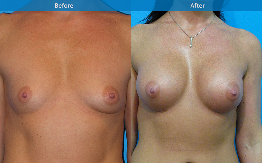 <h3>Case 6</h3><p>Female 41, requested moderate size breast enlargement that is proportionate to her muscular physique. She requested fullnesss to the upper part of her breasts so she does not have to wear push up bra but not " ball like or obviously fake"</p><p>High profile round implants were used to create a full D cup breasts that provide the upper pole fullness requested but also enhance her cleavage. The new breasts provide softening to her otherwise muscular physique without creating the bulk from excessive volume .</p>