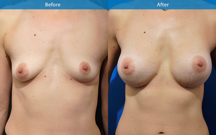 <h3>Case 8</h3><p>35F requested moderate breast enhancement to fill up the emptiness in her breasts and to provide some breast lift following 2 pregnancies. She preferred them to look so natural that others would not be able to tell.</p><p>High profile round implants were used to fill up the emptiness and to provide fuller look as requested and to lift the slightly droopy breasts resulting in a nicely enhanced D cup breast.</p>