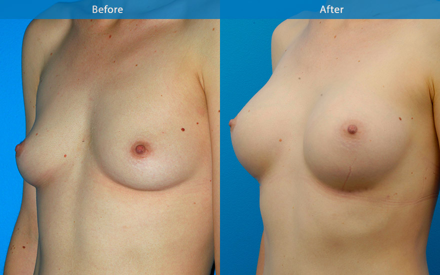 <h3>Case 9</h3><p>Female 36, like to have a moderate and natural breast enhancement . Main request was that it looks natural with or without clothing. Like to have some fullness to the upper part of breasts but not excessive.</p><p>This patient had reasonable breast shape and form. Round moderate profile implants were used to provide fullness, improve cleavage and outer breasts. The new breasts look and feel soft and natural as per her requests.</p>