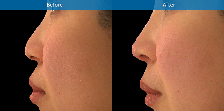 <h3>Case 1</h3><p> 38 Asian female requested  nonsurgical improvement to her nose appearance. Dermal filler was placed in the nasal bridge and to the base and tip of the nose. The 3D photos showed the total transformation to her nose, with a better nose profile and a more refined nasal tip. </p><p>Expected duration: ~ 15 months.</p>