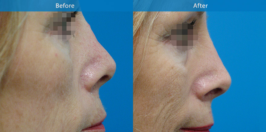 <h3>Case 2</h3><p>58 F with previous nose trauma and scarring. The crookedness and irregularities are corrected with the use of dermal fillers. In literally 10 mins, the nose is  in better shape, straighter and more attractive.</p><p>Expected duration: ~ 15 months. </p>