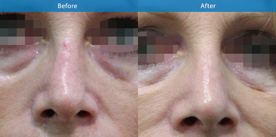 <h3>Case 2</h3><p> 58 F with previous nose trauma and scarring. The crookedness and irregularities are corrected with the use of dermal fillers.  In literally 10 mins, the nose is  in better shape, straighter and more attractive.</p><p>Expected duration: ~ 15 months.</p>