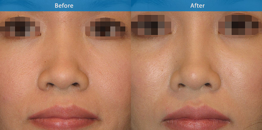 <h3>Case 3</h3><p>34 year old Asian with shallow nasal bridge. She underwent nonsurgical nose shaping with dermal filler. In literally 10 mins, the nose is  in better shape, creating a nicer aesthetic appearance, with definition between the eyes.</p><p>Expected duration: ~ 15 months.</p>