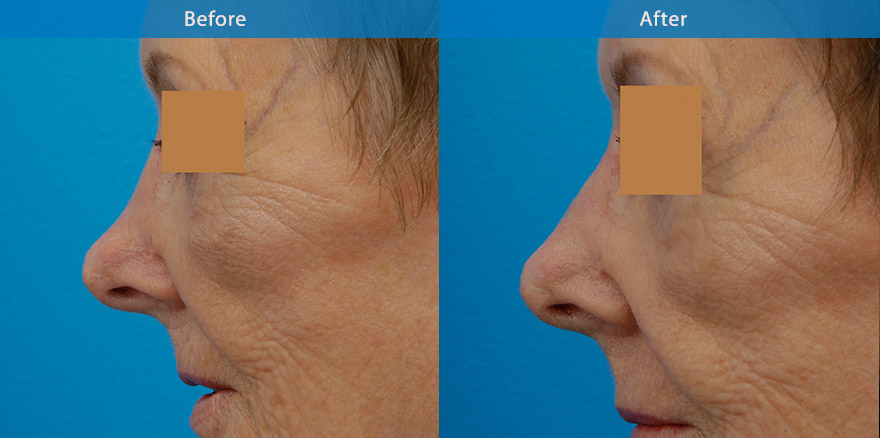 <h3>Case 4</h3><p> 59 F with previous suboptimal rhinoplasty, where the bridge was excessively lowered. She underwent nonsurgical nose reshaping with dermal filler. In literally 10 mins, the nose is  in better shape, straighter and more attractive.</p><p>Expected duration: ~ 15 months.</p>