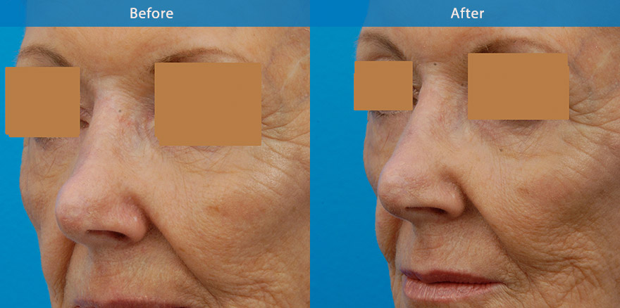 <h3>Case 4</h3><p> 59 F with previous suboptimal rhinoplasty, where the bridge was excessively lowered. She underwent nonsurgical nose reshaping with dermal filler. In literally 10 mins, the nose is  in better shape, straighter and more attractive.</p><p>Expected duration: ~ 15 months.</p>